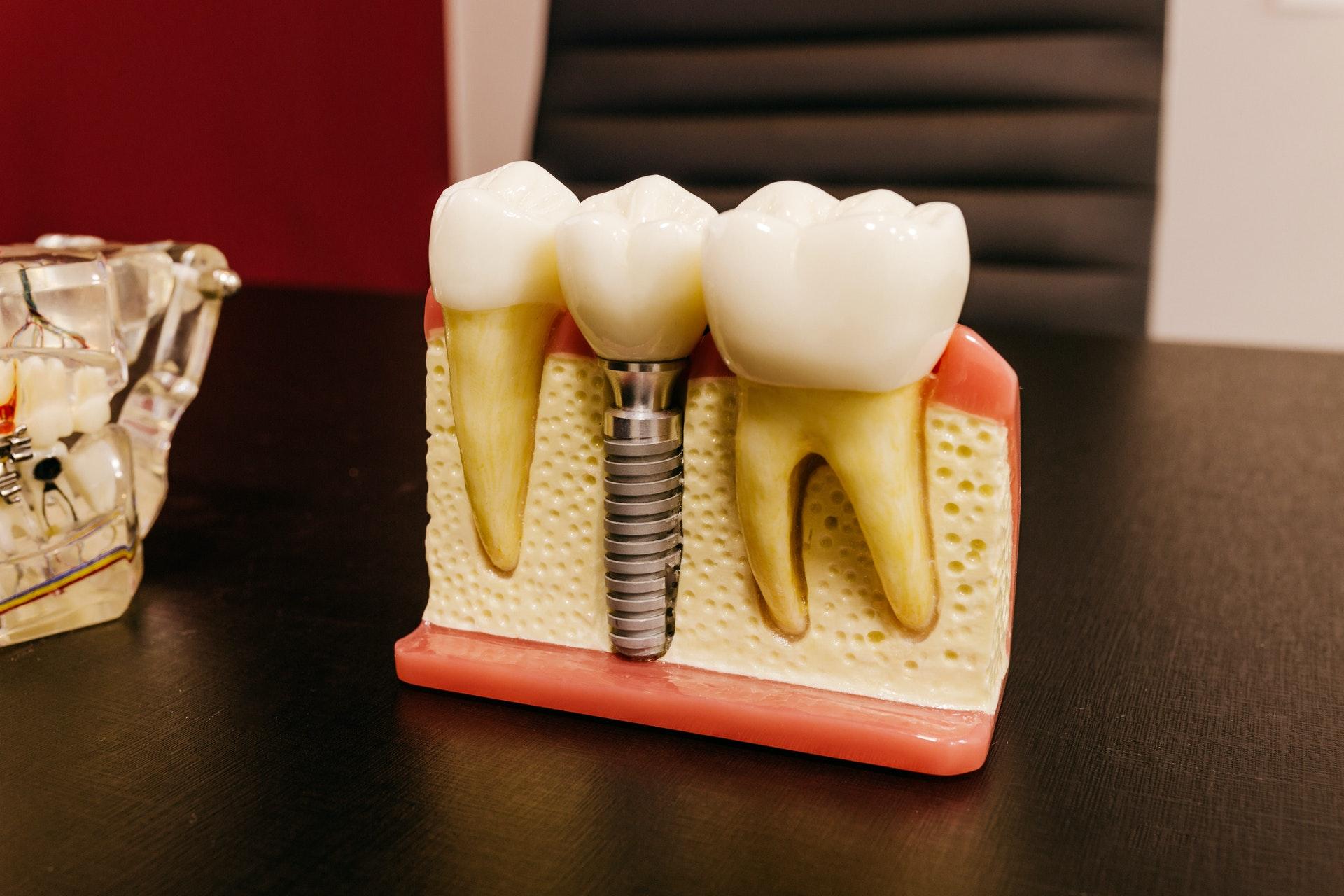 Cómo se hacen los implantes dentales