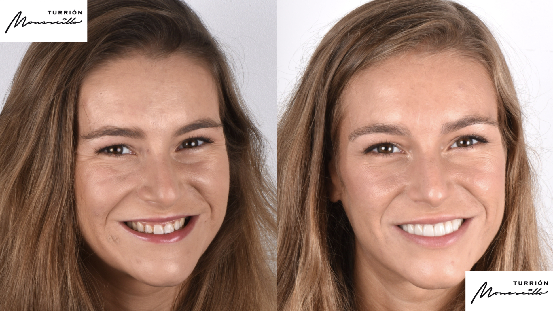 Implantes Dentales y Carillas