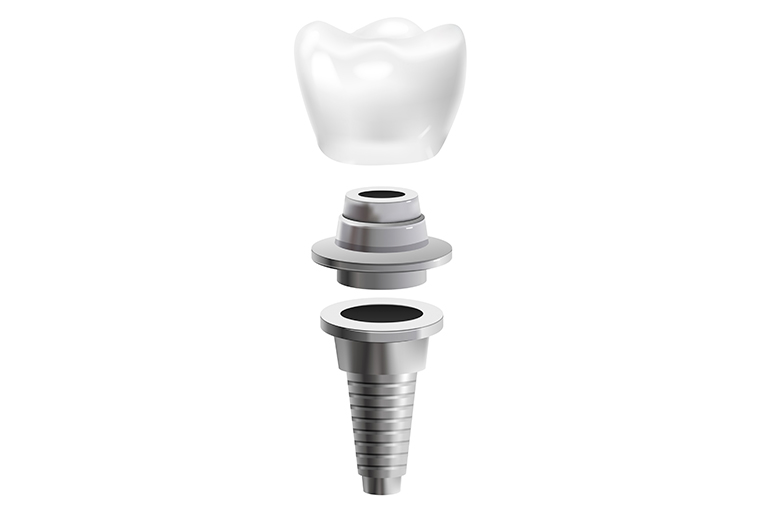 ventajas-implantes-con-carga-inmediata