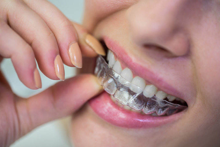que-considerar-al-elegir-un-ortodoncista-invisalign