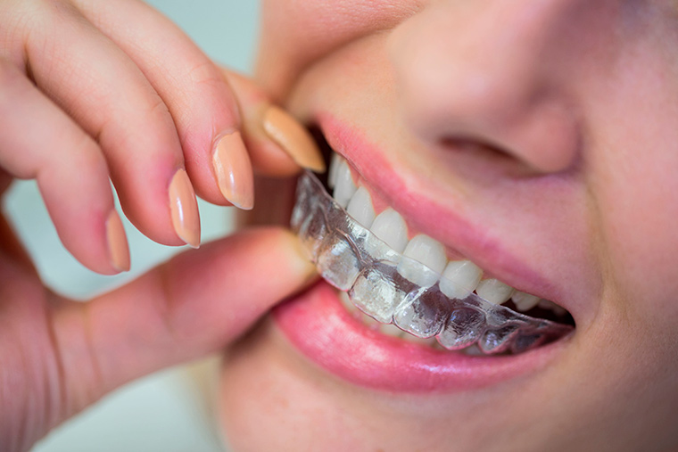 beneficios-de-la-ortodoncia-invisible