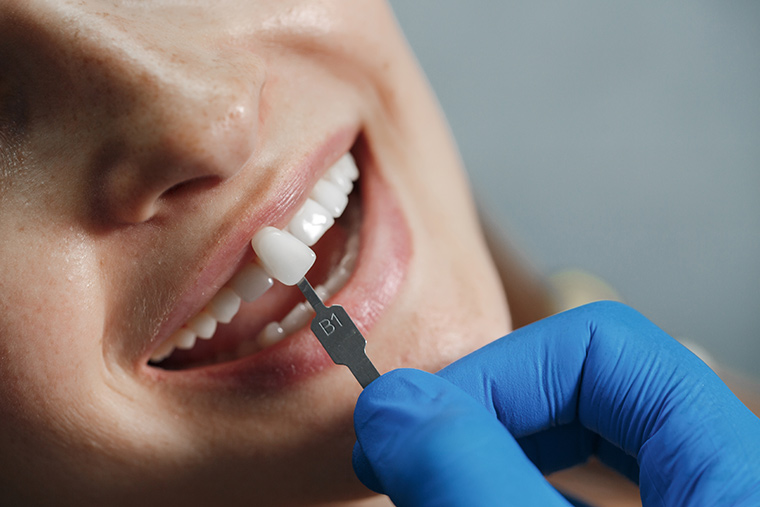 microcarillas-dentales